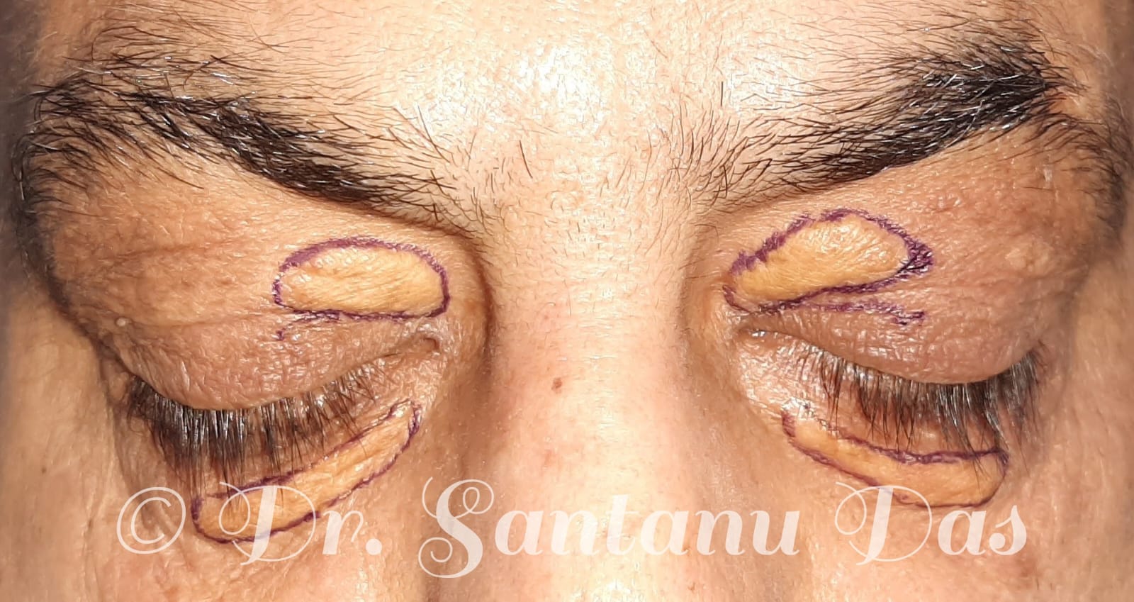 Right upper and lower lid xanthelasma